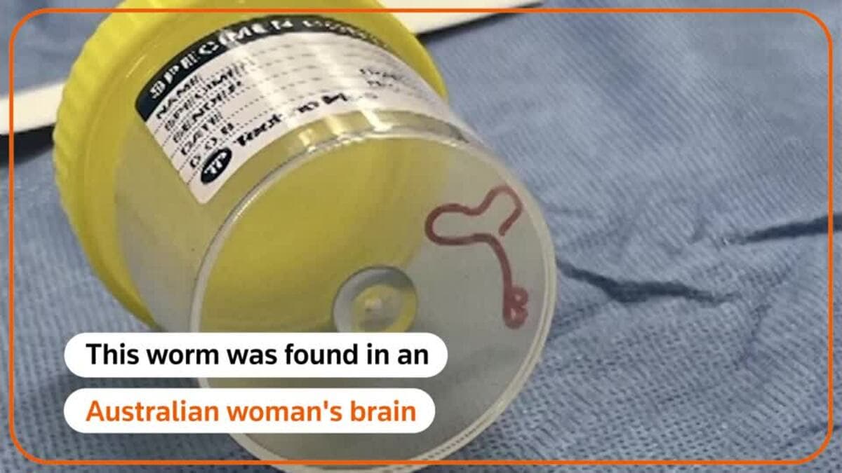世界初、女性の脳から寄生性線虫を発見（オーストラリア） | 記事